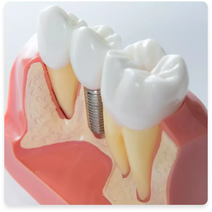 Implanturi dentare