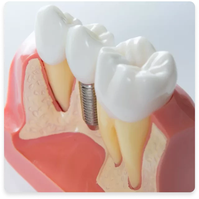 Implanturi dentare