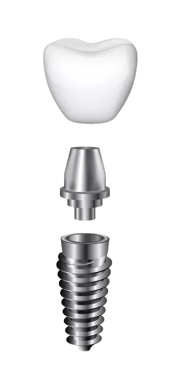 Componentele unui implant dentar